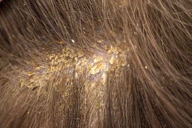 How Dandruff affects your hair and the top 5 ways to treat it ...