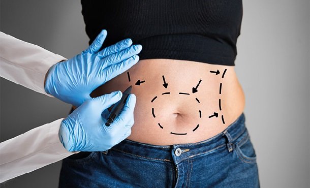 Liposuction Procedures